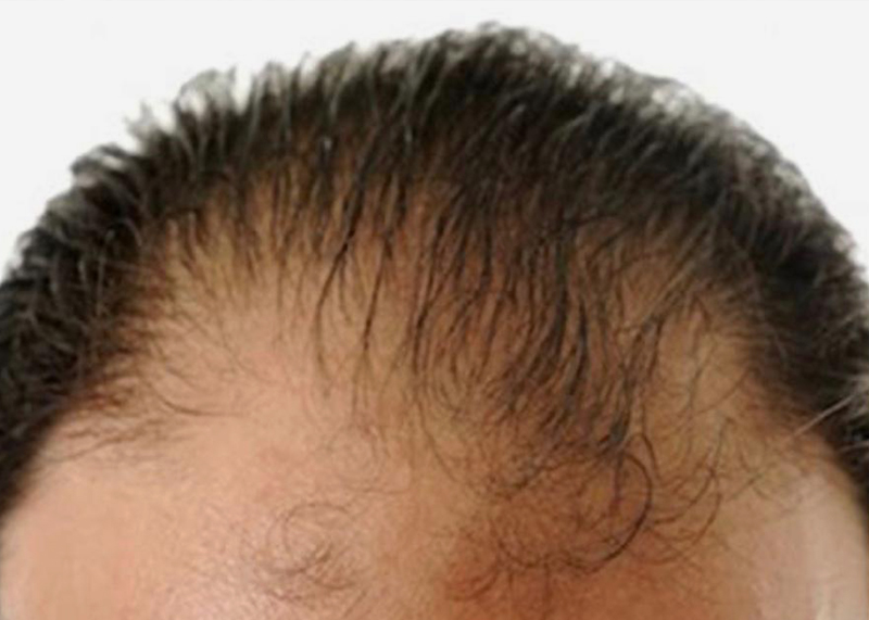 Alopecia masculina