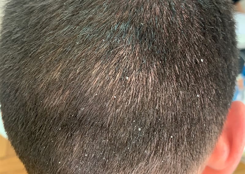 Dermatitis seborreica cuero cabelludo