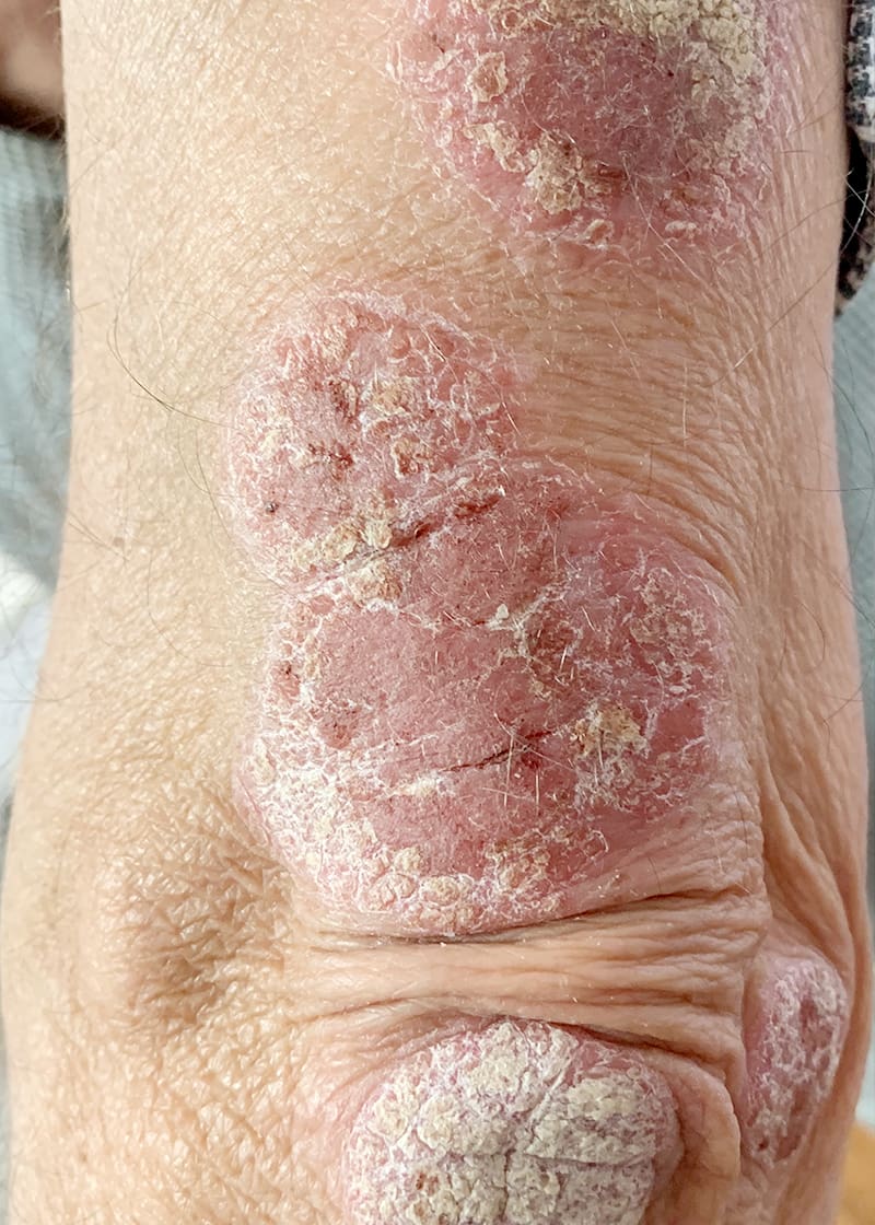 Psoriasis